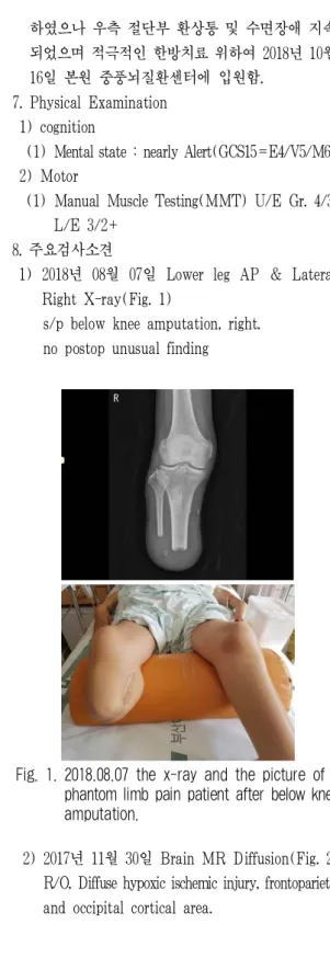 Fig. 1. 2018.08.07 the x-ray and the picture of a phantom limb pain patient after below knee amputation.