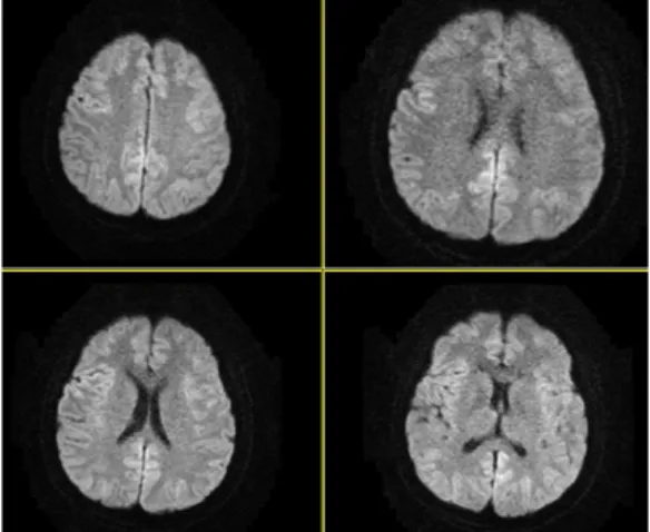 Fig. 2. 2017.11.30 brain MR DWI image.