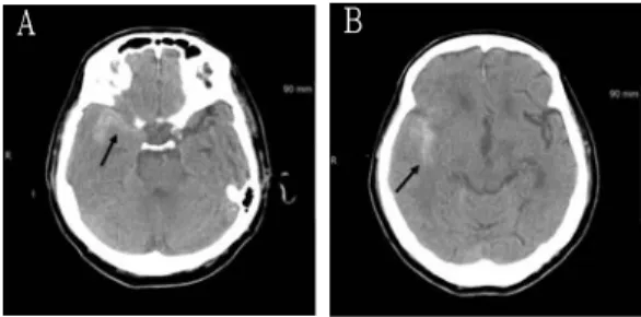 Fig. 2. Noncontrast computed tomography image  of the 78-year-old woman.