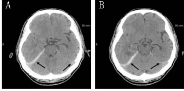 Fig. 4. Noncontrast computed tomography image  of the 64-year-old man.