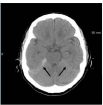 Fig. 5. Noncontrast computed tomography image  of the 79-year-old woman.