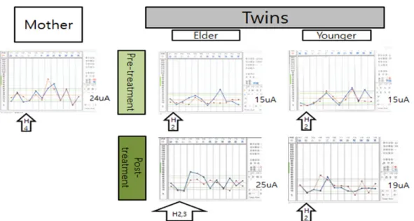 Fig.  1.  Ryodoraku  score  and  bilateral  drop  position  under  the  physiological  interval  of  electrical  skin  response in mother, elder and younger twins between pre- and post-treatment