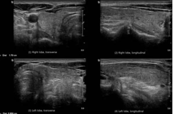 Fig. 1. Thyroid sonography (1)~(2) : right lobe,  (3)~(4) : left lobe.  3) 갑상선 스캔 및 테크니슘 섭취 검사 : ⃝⃝대학 병원 핵의학과에서 방사성 동위원소(Technetium  -99m)를 이용한 갑상선 스캔 및 테크니슘 섭 취 검사 상 갑상선 우엽에 냉결절(cold nodule) 과 중등도로 증가된 방사성 동위원소 섭취량 이 확인되었다