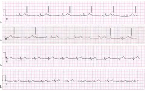 Fig. 3. Change of electrocardiograph.