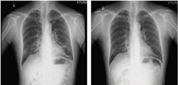 Fig. 2. CXR PA (Lt.) 2015.4.29. (Rt.) 2018.1.4. Ⅳ. 고 찰 기관지확장증은 만성 호흡기 질환으로, 기침, 객 담 및 기관지 감염 등을 일으키며 방사선학적으로 는 기관지의 비정상적, 영구적 확장을 특징으로 한 다
