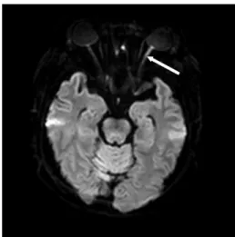 Fig. 2. Brain magnetic resonance imaging (diffusion  -weighted image, transverse view).