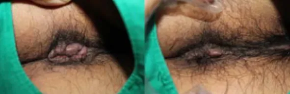 Fig. 2. Case before and after pictures of 42 years  old patient. left : 2017.09.23, right : 2017.11.13 <증례 3> 1