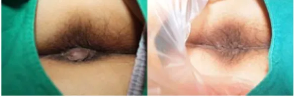 Fig. 4. Case before and after pictures of 70 years  old patient. left : 2018.02.19, right : 2018.03.10 Ⅳ
