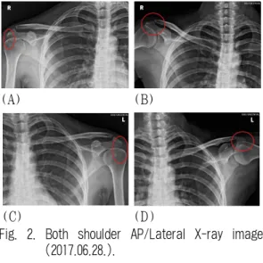 Fig. 1. Brain diffusion weighted image (A) and T2 flair image (B) (2016.12.12.).