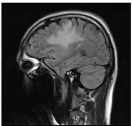 Fig. 2. B-MRI T2 flair (2015.09.22).