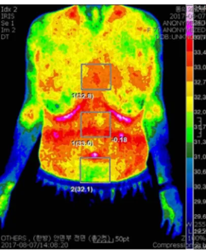 Fig. 3. Abd thermography.