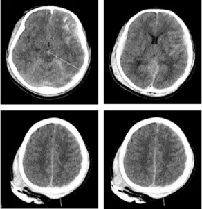 Fig. 2. Brain MR diffusion in case 2 (2016.03.23).