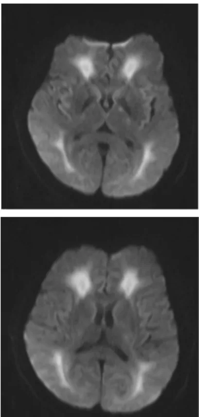 Fig. 3. Brain MR diffusion in case 3 (2016.05.05). 10. 처치 및 투약  1) 침구치료 : 0.25×0.30 mm(동방침구사)의 호침 을 사용하여 1일 1회 GV20(百會), GV24(神庭),  ST8(頭維), 양측 LI11(曲池) LI4(合谷) GB34  (陽陵泉) ST36(足三里) SP9(陰陵泉) LR3(太 衝)의 혈위에 자침하였고 20분 유침 하였으며  유침 시간동안 적외선조사요법을  병행하였다