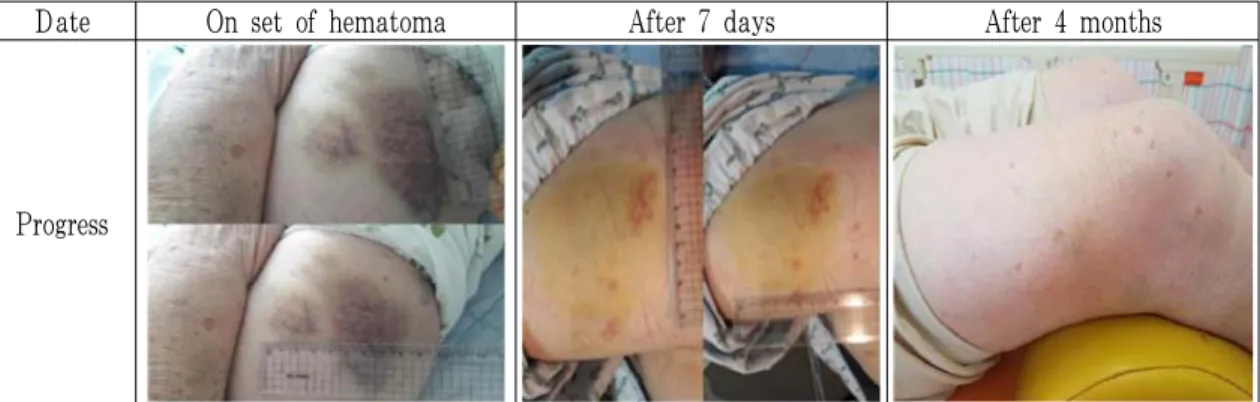 Fig. 3. The report of hematoma occuration at lateral compartment area of Rt. leg.