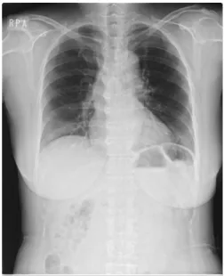 Fig. 1. Chest PA view.