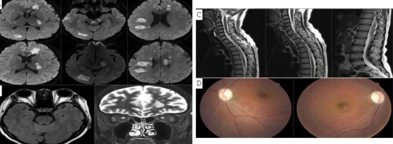 Fig. 1. Brain magnetic resonance imaging (diffusion weighted imaging) (A), orbit brain magnetic resonance  imaging  (T2  weighted  axial  imaging,  short  tau  inversion  recovery  coronal  imaging)  (B),  whole  spine magnetic resonance imaging (T2 weight