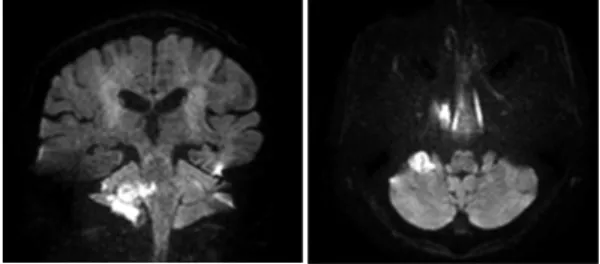 Fig. 1. 2016.05.05 Brain diffusion-weighted magnetic  resonance imaging.  6) 이학적검사   (1) Finger to nose(+/-)   (2) Heel to shin(-/-)   (3) Romberg test(+)   (4) Tandem gait(+) 9