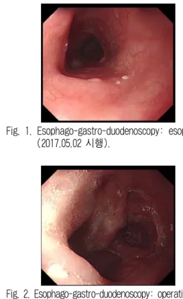 Fig. 1. Esophago-gastro-duodenoscopy: esophagus  (2017.05.02 시행).