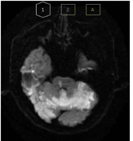 Fig. 1. Brain MRI AXL DW1 scan (2017.05.08).