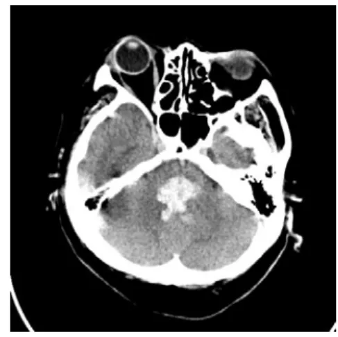 Fig. 1. CT brain (2017-02-28).