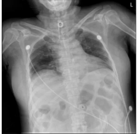 Fig. 2. Chest AP (2017-07-31). Fig. 3. Chest AP (2017-08-08). 8. 초진소견  1) Respiratory disturbance   (1) 환자는 뇌교출혈 이후 발생한 호흡장애를 호 소하고 있던 상태로, 입원 당시 산소포화도 가 불안정하여 O 2 를 적용하지 않으면 정상 적인 산소포화도를 유지하지 못하고 저산소 증을  보이는 상태였다