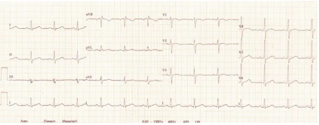 Fig. 2. Electrocardiogram of patient 2.