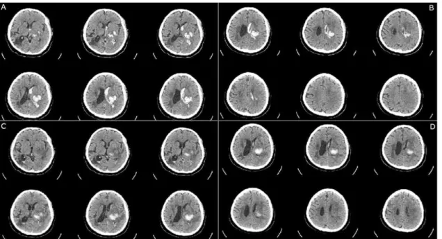 Fig. 1. Brain CT scan without enhancement (A, B : 2016-05-07 C, D : 2016-05-18). 10. 치료(입원기간 : 2016년 6월 14일~2016년 11월 29일, 169일간) 1) 침 치료 : 입원 일부터 행림서원 제품 일회용 0.20×30 mm stainless steel 호침을 사용하여 1 일 1회 자침하였고 15분간 유침(留鍼)하였다.