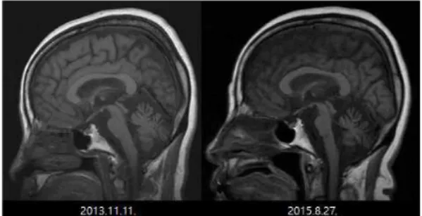Fig. 2. Brain MRI T2 flair axial view.