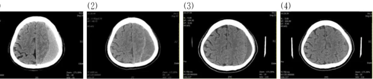 Fig. 1. Changes of brain computed tomography (CT) imaging during the follow up period.