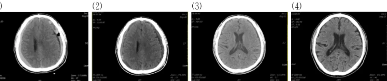 Fig. 2. Changes of brain computed tomography (CT) imaging during the follow up period.