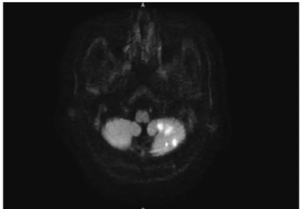 Fig. 2. Brain MRI (T2) 7 days after onset.