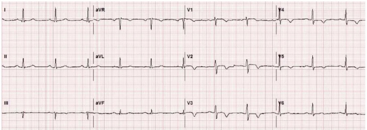Fig. 2. 2017-01-09 EKG.
