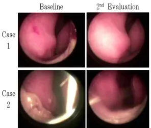 Fig. 3. Nasal mucose membrane of baseline and second evaluation. 3. 상관관계 1) 寒熱辨證 설문지와 임상증상 寒熱辨證 설문지의 熱證, 寒證 점수와 기침⋅가 래 임상증상 평가 기준, LCQ-K, VAS, TNSS 총점 사이에 상관성을 보았다