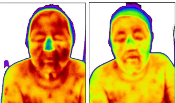 Fig. 2. DITI (before &amp; after treatment). 2016/06/17 2016/06/30 2016/07/14 Frequency 7 4 2 Intensity 4 4 2 Score (Frequency x intensity) 28 16 4 PSQI (0-21) 13 6 4