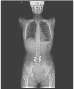 Fig. 1. Whole-spine AP view.
