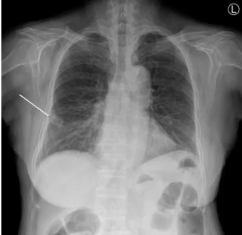 Fig. 2. Before operation. about 1.8 cm sized cavitary  nodule at right lower lung zone.