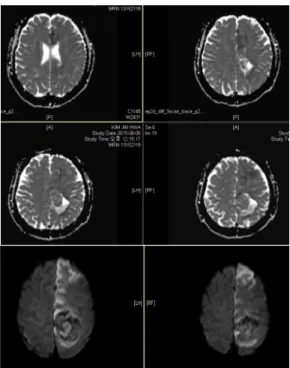 Fig. 2. Diffusion weighted images show high signal  intensity in left ACA territory.