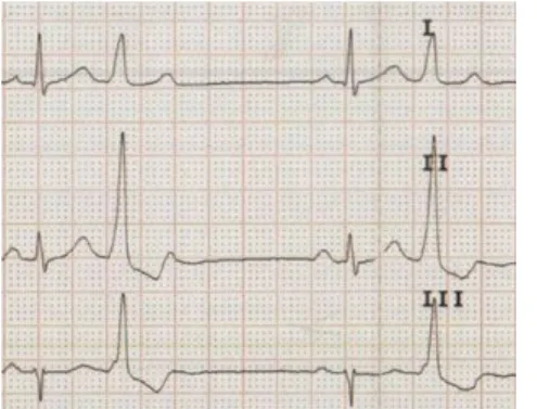 Fig. 2. Electrocardiogram #1 lead I, Ⅱ, Ⅲ (2015-  11-13, before the treatment).