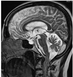 Fig. 1. Brain MRI T2 sagittal section (2015.05.29).