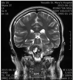 Fig. 4. Brain magnetic resonance imaging pictures  of the case. 한약 치료로 사용한 釣藤散은 南宋 許叔微의 ≪普 濟本事方≫의 處方으로 15  平肝熄風하는 釣鉤藤, 甘 菊, 理氣化痰하는 半夏, 乾薑, 陳皮, 補氣健脾하는  茯苓, 人蔘을 배합하여 熄風, 健脾化痰하여 氣虛挾 痰의  肝風內動을  치료하는  방제로서 16 ,  만성두통,  뇌혈관질환, 고혈압에 효과가 있고 뇌혈류개선에도  유의한  것으로  알려져 