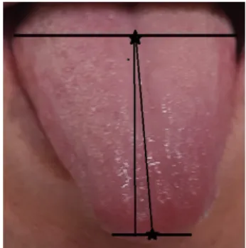 Fig. 1. Measurement of Tongue Deviation Angle.