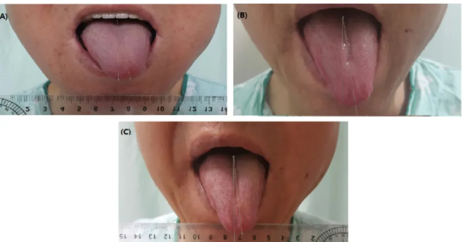Fig. 3. Clinical progress of tongue deviation.  (A) 2016.06.15. (B) 2016.06.21. (C) 2016.06.26