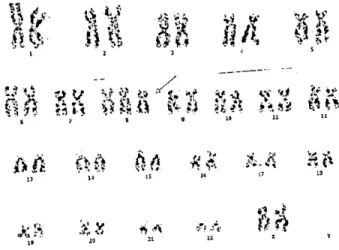 Fig. 1. Chromosome analysis of patient in case 1.