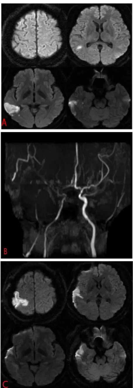 Fig. 1. Brain magnetic resonance imaging (diffusion weighted imaging). 13. 치료내용 및 시술방법1) 한약치료 다음의 처방을 2첩 분량으로 1일 3회 服用하였다.(1) 萬金湯加味6, 2015년 9월 21일-12월 29일 :甘草 4 g, 桂皮 4 g, 當歸 4 g, 杜仲(炒) 4 g,防風 4 g, 白茯苓 4 g, 細辛 4 g, 續斷 4 g,牛膝 4 g, 人蔘 4 g, 羌活 4 g, 半夏(薑半) 4 g