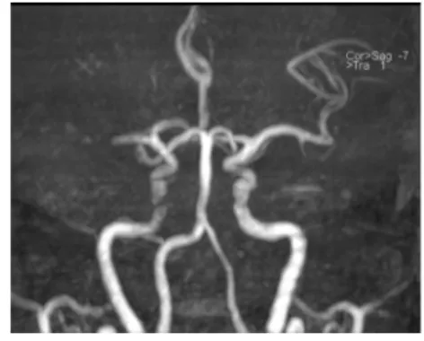 Fig. 2. Brain magnetic resonance imaging (diffusion weighted imaging), brain magnetic angiography 13