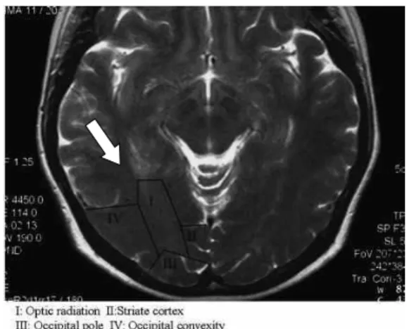 Fig. 6. The region of the occipital lobe associated with visual areas.