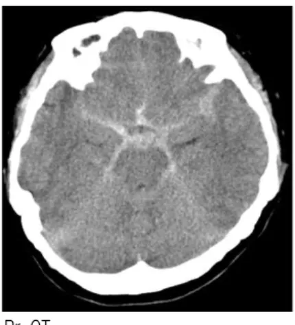 Fig. 1. Br-CT. 10. 입원 기간 : 2013년 04월 18일-2013년 06월 07일 (51일간) 11. 치 료 1) 한방치료 (1) 두침치료 : 전기자극을 가한 두침치료를  월-토 1일 1회로 총 6회/주 시행하였다