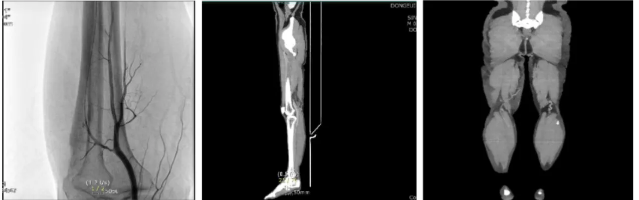 Fig. 1. CT pulmonary embolism &amp; DVT of a patient.