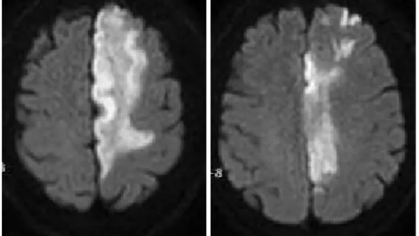 Fig. 1. Diffusion weighted images show high signal intensity in left anterior cerebral artery territory.