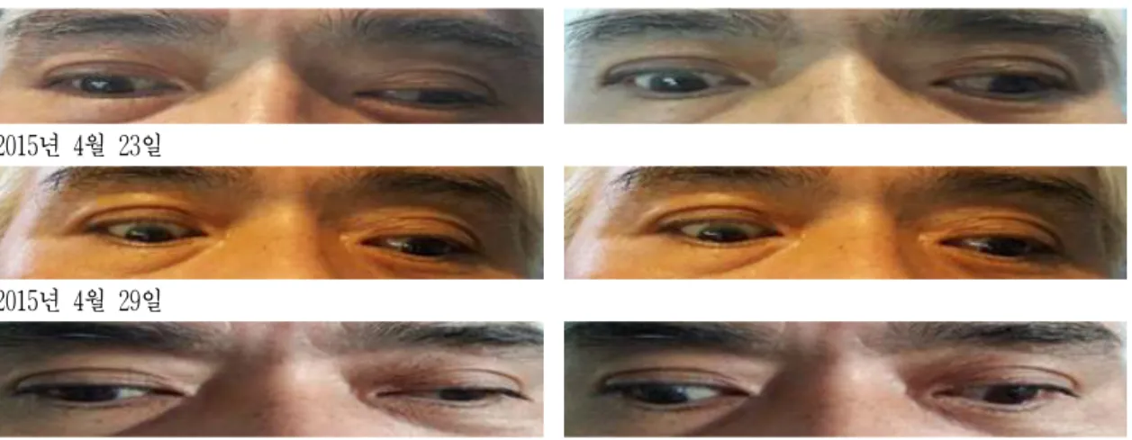 Fig. 2. Change in eye movement of adduction and abduction.